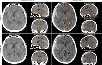 Automated volumetric evaluation of intracranial compartments and cerebrospinal fluid distribution on emergency trauma head CT scans to quantify mass effect